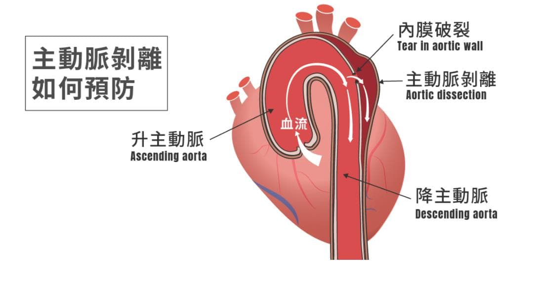 主動脈剝離如何預防？